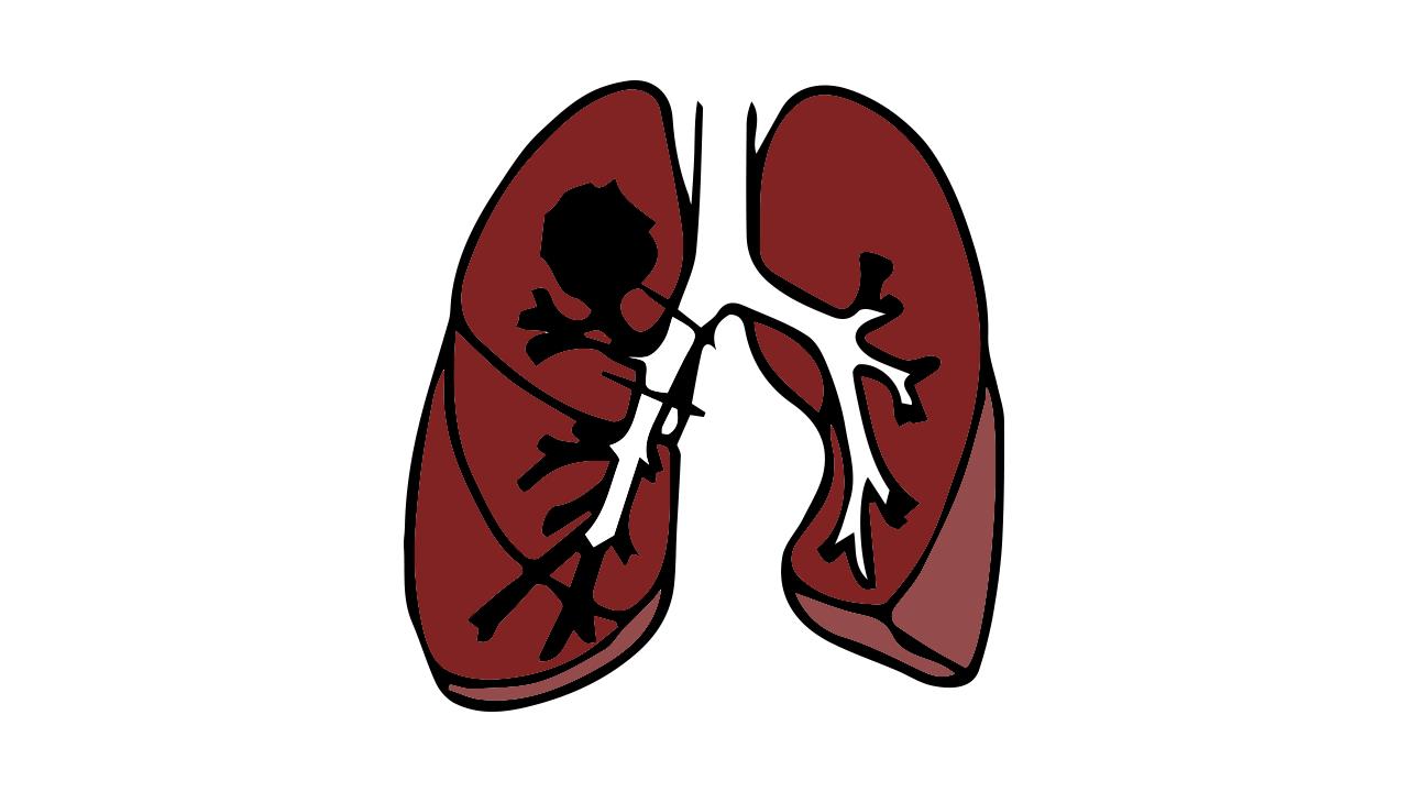 肺炎简笔画怎么画 肺炎简笔画简单